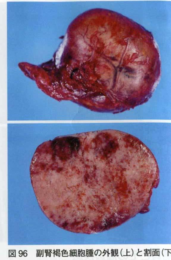 褐色細胞腫 クロム親和性細胞から発生する腫瘍