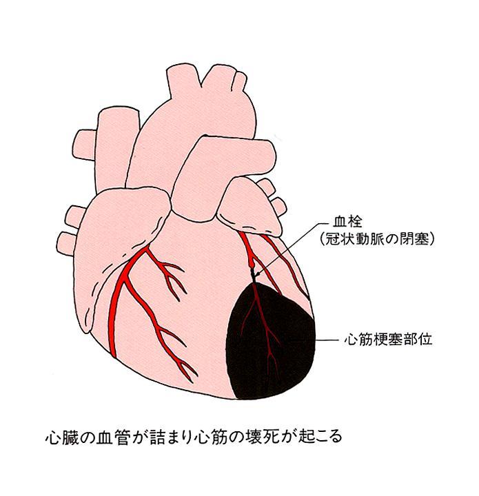 責任冠動脈と心筋梗塞