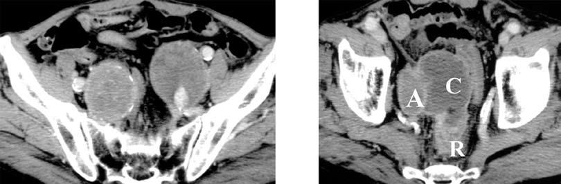 3 Figure 1 Contrast-enhanced computed tomogram of case 1.