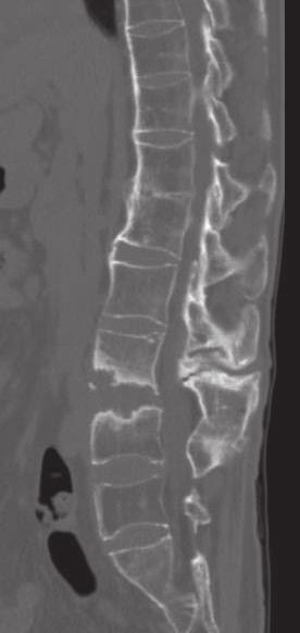 479 図 3 2 症例 2: 腰椎 CT L4/5 間での骨性終板のびらん性変化と後方棘突起に骨折線を認める 図 3 3 症例 2: 術後腰椎正面像 () および側面像 () 載がなされている 6) それによると,1) 年齢に関係なく関節痛や機能障害, 画像上の関節破壊が明らかな場合は TH を考慮すべきである, 2) 機能障害をきたすような脊柱変形については矯正骨切りを考慮してもよい,3)
