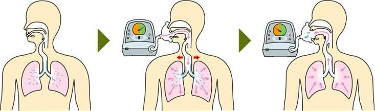 排痰補助装置とは 気道に陽圧をかけて肺に空気をたくさん入れた後に