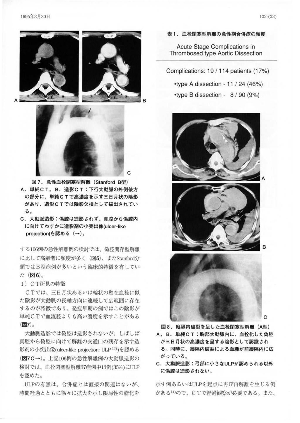 199 5 年 3 月 30 日 表 1. 血栓閉塞型解離の急性期合併症の頻度 図 7. 急性血栓閉塞型解離 (Star ford B 型 ) A. 単純 C T, B. 造影 CT: 下行大動脈の外側後方 の部分に 単純 CT で高濃度を示す三日月状の陰影 があり る 造影 CT では陰影欠損として描出されてい C.