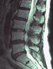 正常な脊柱 坐骨神経