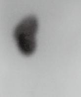 図 23 4 歳片腎男児の DMSA シンチグラム像左腎しか描出されていない.
