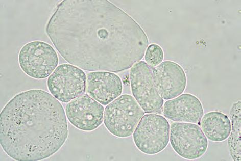 The middle layer squamous epithelial cells have poor stainability, and the granule components are scattered on the cytoplasmic surface. Figure 3.