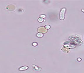 components such as fatty granules. In swollen macrophages, the marginal structure of the cytoplasm has a circular or near-circular shape. Phagocytosed dead cells (e.g., WBCs or RBCs), cellular fragments, crystals, and fatty granules may be observed in the cytoplasm.