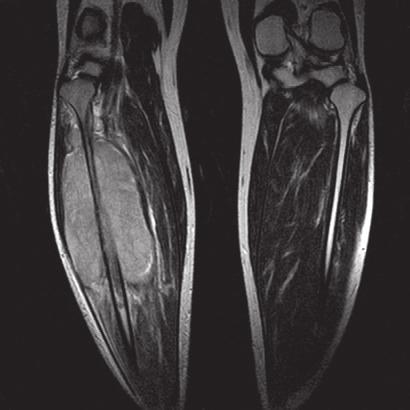 単純 X 線所見では 弓状の反応性骨形成 ( オニオンピール ) といわれる骨の異常が特徴的です 肉腫がどのくらい広がっているかを確かめるために CT MRI などを使って詳しい検査が行われます