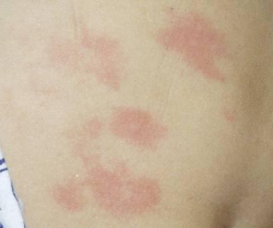 図 3 じんま疹と湿疹 じんま疹 湿疹 急に出現する皮膚の赤みと腫れ 皮膚の表面は滑らかで 時間が経つと跡形もなく消失する 治療には 抗ヒスタミン薬が使われる 皮膚の表面がガサガサ ジクジクして荒れた状態 即時型アレルギーで急に出現することはなく 治るのに数日かかる 治療には ステロイド軟膏が使われる 表 1 食物アレルギーにより引き起こされる症状 皮膚症状 かゆみ じんま疹 赤み ( 赤斑 )