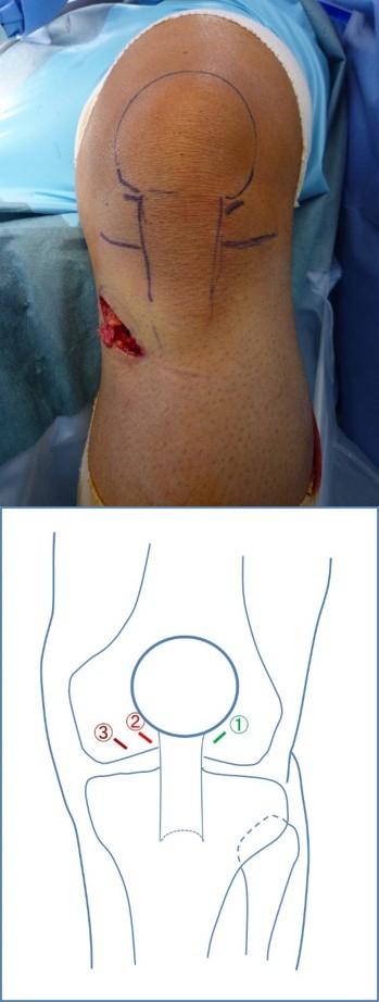A B 図 2. 関節鏡手術に用いるポータルの位置 ( 左膝 ) A.