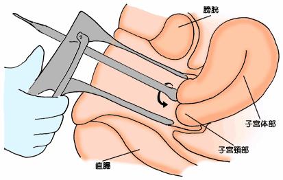 細胞診とは 子宮粘膜を採取器具 ( 綿棒 へら ブラシ等 ) で 擦って細胞を採取し