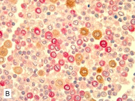 抗体の 2 重染色 ニューフクシン発色 ( 赤 ): 抗 Melan-A 抗体