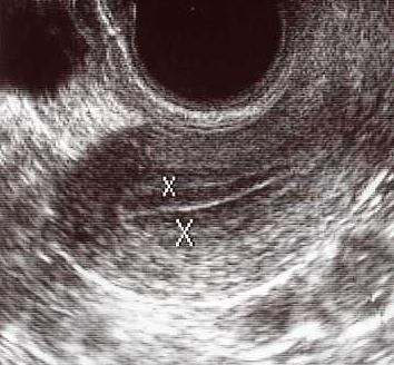 タイミング法上記の検査にて異常所見がなかった場合 夫婦関係のタイミングが排卵とうまく合っていない可能性があります 最も妊娠しやすいのは 排卵前のできるだけ排卵に近い時期といわれておりますので 診察 ( 超音波検査 頚管粘液検査 ) 尿検査 ホルモン検査などを行い 排卵日をできるだけ正確に予測して その直前に夫婦関係をもっていただくように指導いたします