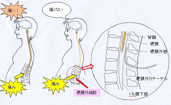 硬膜外無痛分娩で 痛みが取れるしくみを説明します まず左ページの図を見てください これはお産の痛みを伝える神経の走行を示しています 分娩第 1 期の痛みは子宮収縮と子宮頸管の伸展により生じ その痛みは1の下腹神経を経て脊髄に入ります 最も痛いとされる分娩第 2 期の痛みは 主として会陰部の伸展による痛みで その痛みは2の陰部神経を介して脊髄に入ります そして脊髄神経を通って 痛みは脳に伝わります