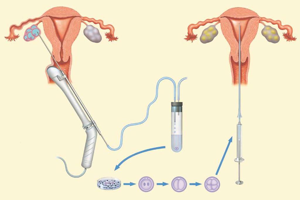 Fertility Cryopreservation