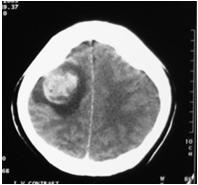 腫瘍マーカー CT 理的産 部位 AFP 胎児 ( 卵 嚢 ) 肝 β-hcg