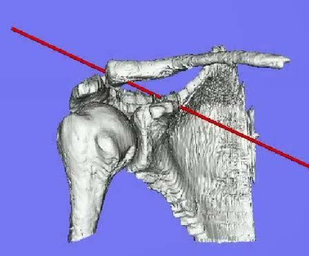どんな役割をしているのかは, 関節の動きを安定化させ, さらに動きを制限せずスムーズな動きを可能にするように最適に形作られていることがわかる. 肩鎖関節の動きとそれに伴う靭帯の構造を見るだけでも, 人間の巧みに計算? された無駄のない素晴らしい構造に敬服するばかりである. ろん肩甲骨も大きく動く.