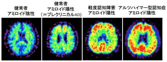 8. 添付資料 : 図 1 J-ADNI におけるアミロイド PET( ピッツバーグ化合物 B; PiB) 陽性度 ( 横軸 ) と脳脊髄液 Aβ(1-42) 定量値 両者を検査した健常高齢者 (CN; 青 ) MCI( 橙 ) 軽症 AD(AD; 赤 ) の値をプロットした アミロイド PET 陽性例 ( 縦の赤線より右 ) は脳脊髄液 Aβ(1-42) 低値 ( 横の 赤線より下 )