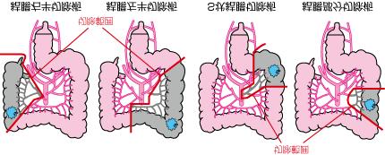 部位とがんの進行度から判断して決定します 切除後 腸の切り口をつなぎ合わせます ( 吻合 ) 大腸は全長が1.