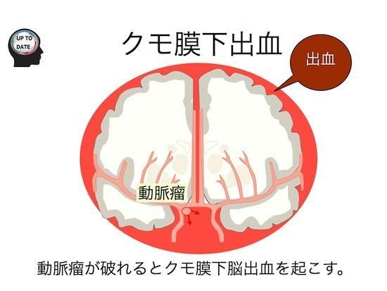 11 12 出血性脳血管障害 くも膜下出血脳出血 1) くも膜下出血 主に脳の動脈にできたこぶ ( 脳動脈瘤 ) が破裂して 脳を包む くも膜