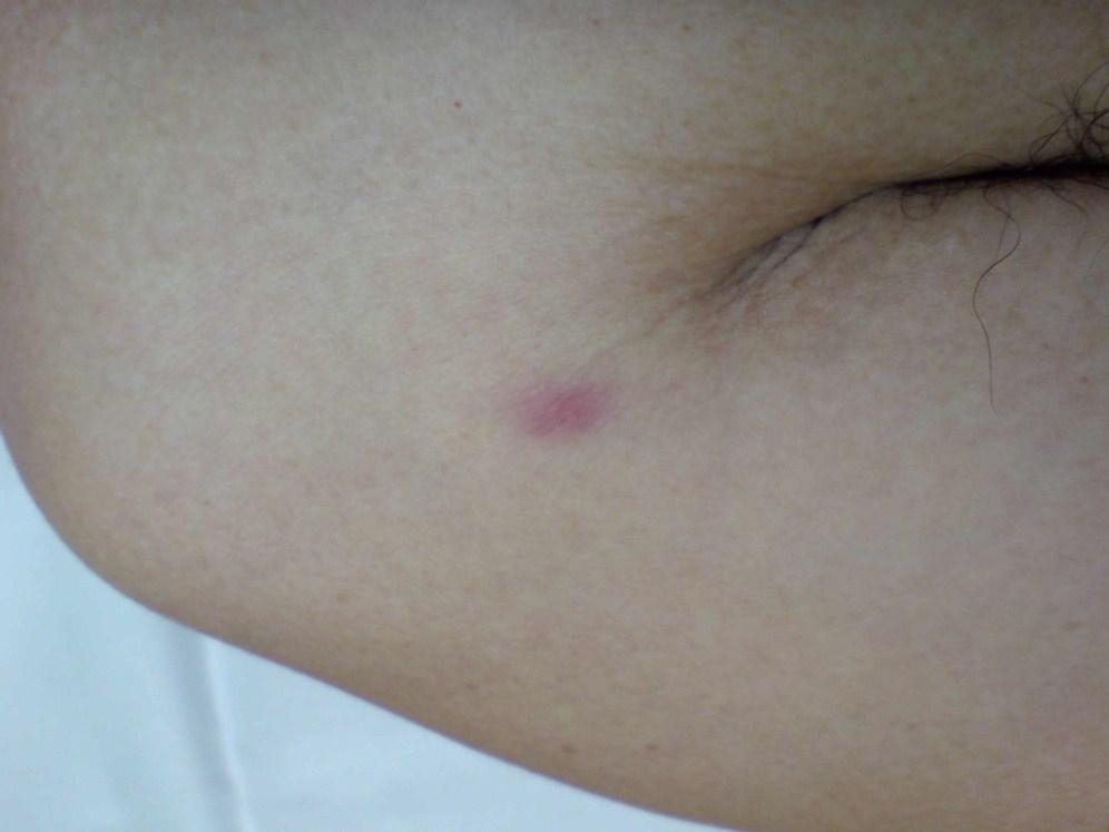 箇所に分けて皮内注射 48 時間後の反応 数ヶ月 ~2 年 丘疹が残る毎週数ヶ所ふえる