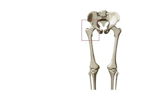 2. 大腿骨頚部骨折 Q: 大腿骨とはどこの骨ですか? A: 脚の付け根から膝までの骨です Q: どんな人に起きやすい骨折ですか? A: 骨粗鬆症の方が転ぶと起きやすい骨折です Q: どんな転び方で起きやすいのですか?