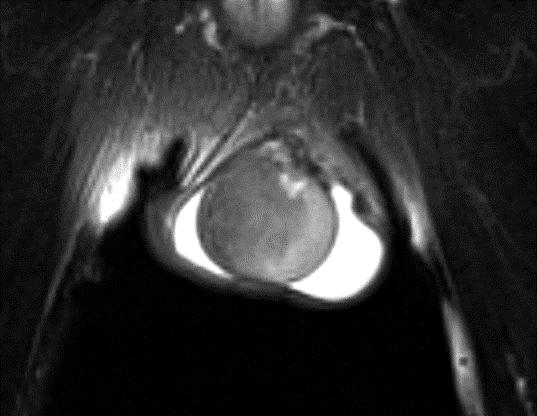 2015 年版 でも胸部 CT の推奨度はグレード A となっている 5) 肺転移は単純 CT でも評価できるが, 肺門部や縦隔のリンパ節を血管と分離して評価するには造影 CT がよい 腹部領域でも, 大血管周囲のリンパ節転移の評価の際に, 血管と小さなリンパ節を区別するには造影 CT が望ましい 若年男性で後腹膜の脂肪がほとんどない場合, 正常大のリンパ節は同定が難しいことがある
