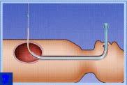 密着させます 体の外からお腹の壁に麻酔を施行し 針を胃の中へ刺します ( 図 1) 図 2 3) 針を通してガイドワイヤーを胃の中に挿入し 内視鏡