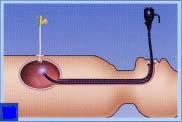 腹の壁の外よりガイドワイヤ - を引いていきます ( 図 3 4) 図 4 5) 管 ( チューブ ) の端にあるバンパーが胃の壁に到着したら10