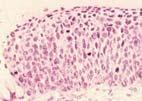 発がん性 HPV の感染と子宮頸部病変の発生 頸がん 45 万人 CIN3: 高度異形上皮 1,000 万人 1000 人に一人 CIN1: 軽度異形上皮