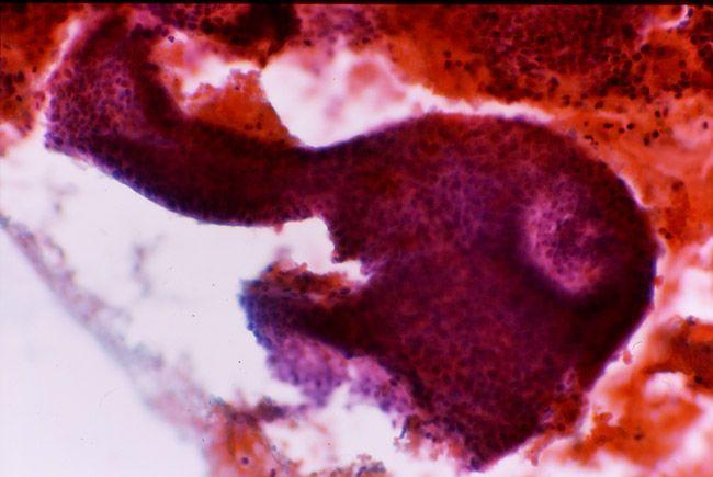類内膜腺癌に出現しやすい細胞所見