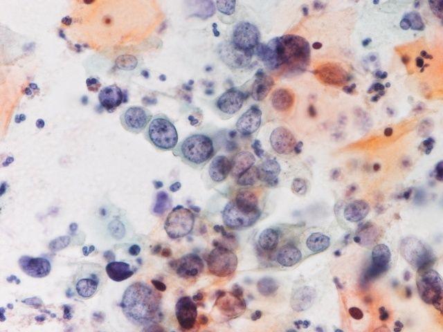 細菌性膣症を示唆する菌叢の転換 形態的に放線菌に一致する細菌