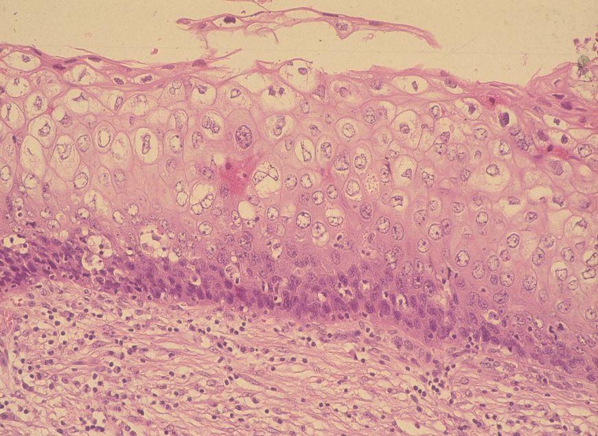 細胞診でLSIL(コイロサイトーシスを含む と診断され るHPV感染所見は 一過性のもので 癌化のリスクは 小さい 生物学的な差異 LSILは HPVの 一過性感染の細胞変化