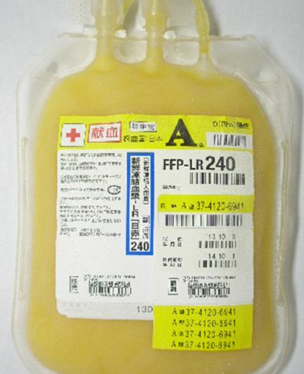 血漿製剤 ( 新鮮凍結血漿 ) 保存法 有効期間 -20 以下凝固因子の保存 採血後 1 年間室温にもどして 3 時間以内に輸血 注射針 20G(24G でも可 ) 輸血セット凝集塊の混入を防ぐ