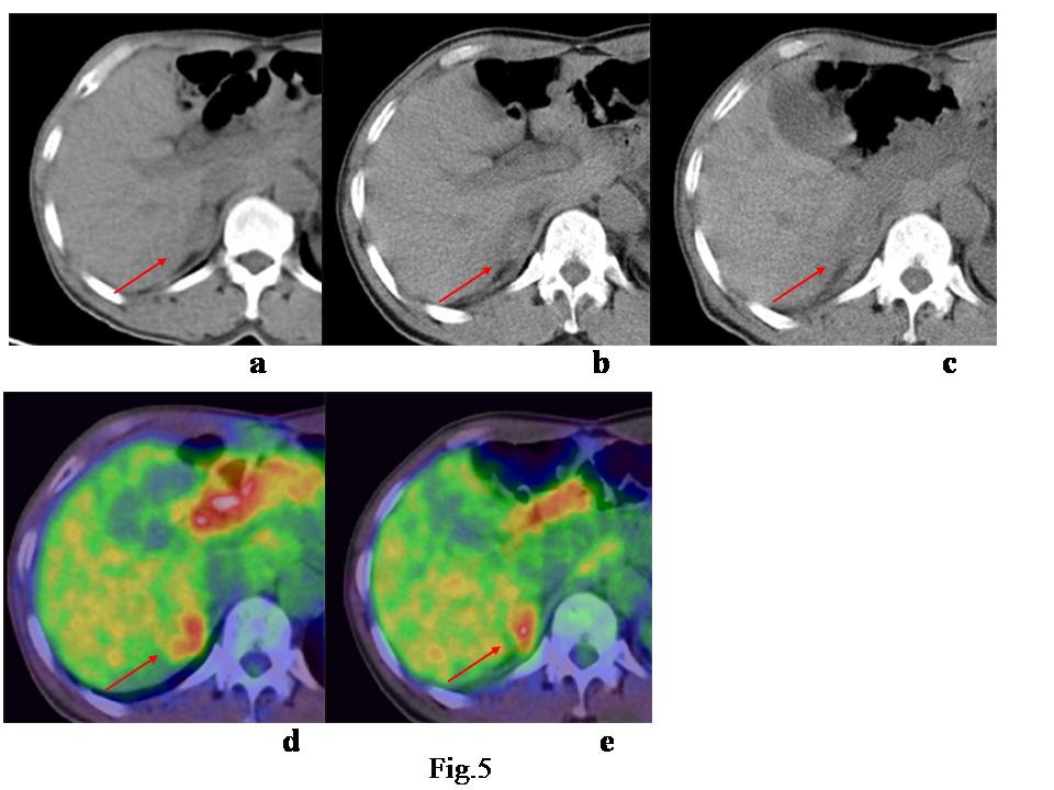 After series of chemotherapy, SUVmax decreased from 13.0 to 8.7. However, the tumor size showed no change in post-chemotherapeutic CT. Finally the case was diagnosed as NR by the follow-up CT.