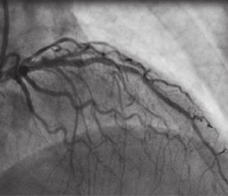 右冠動脈 (right coronary artery;rc) と左冠動脈回旋枝 (left circumflex artery;lcx) 病変は比較的灌流域が小さかったが, 左冠動脈前下行枝 (left axis deviation; LD) の灌流域は大きかったため, アスピリン