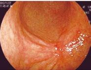 図5 早期胃がん M 20 10mm por1 tu2 ly0 v0 通常光観察遠景 前庭部小彎発赤調の陥凹性病変が認められる