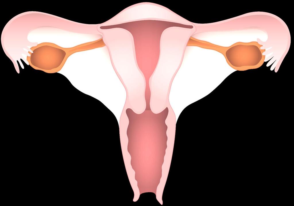 婦人科がん ( 子宮頸癌 子宮体癌 卵巣癌 ) に対する一般的な術式 単純子宮全摘術 ( 筋膜外