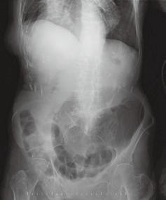 multiple longitudinal insults of serosa was observed (arrow). 盲腸と同定可能であった. またwhirl signを認め, 盲腸軸捻転症と診断した. 腹水も認められ, 腹部所見と併せ, 腸管壊死を疑った.