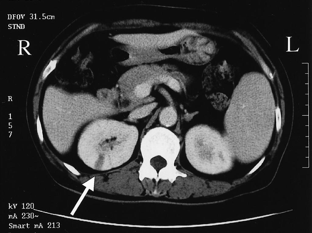 enhancement arrows in the spleen left and right kidney right 7 17 10 8mm 7 28 9 9mm 8