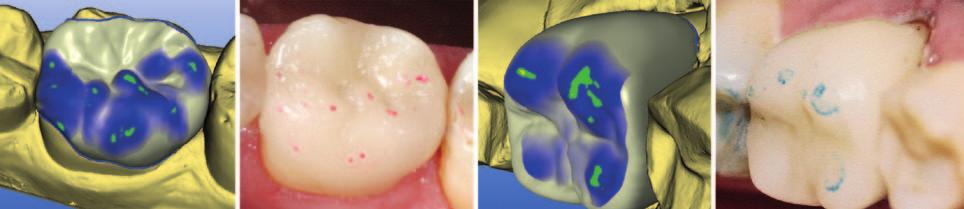 CERECバイオジェネリックソフトウェアは 形成済みの歯の窩洞周囲に残る咬合面の組織を利用します クラウンの場合 ユーザーは