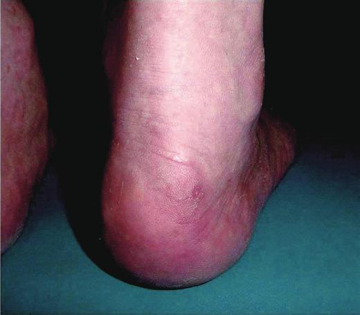 アキレス腱症 ❺ Haglund 病 a: 踵部後外側に骨性膨隆 ( ) を認める. b: アキレス腱付着部外側に骨隆起 ( ) を認める. アキレス腱症では, 潜在性の高脂血症を含め基礎疾患の有無にも留意する必要がある.