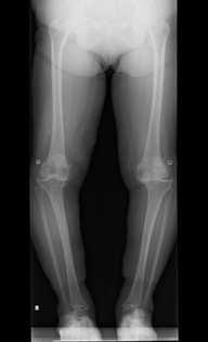 変形性膝関節症の症状 立位や歩行時 赤い線のように体重 が膝にかかると 膝は矢印のように外側へ動揺する