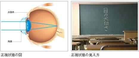 で網膜に焦点を結ぶ状態 平行光線が無調節状態の眼に入ったとき 焦点が網膜の後方にくるもの