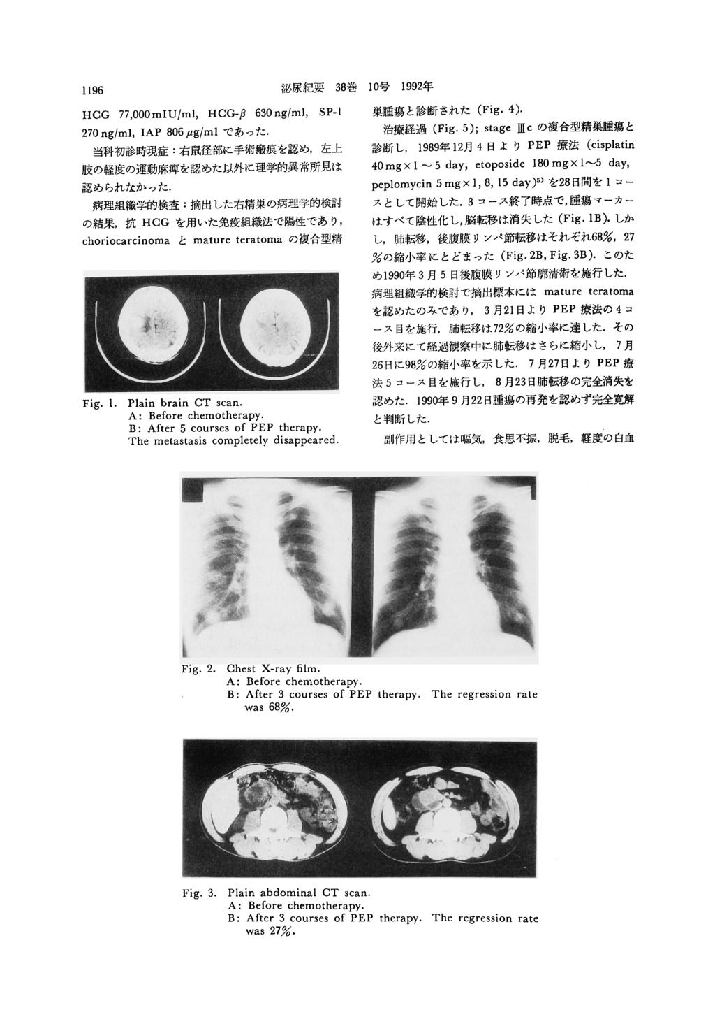 泌尿 紀 要38巻10号1992年 1196 cg77,000miu/ml,cg 巣 腫 瘍 と 診 断 さ れ た(Fig.4).