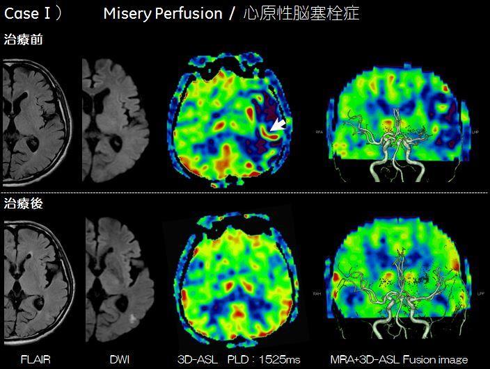 DWI では左側中大脳動脈領域に非常に淡い高信号が見られ 3D ASL では DWI と同部位を含む MCA 領域に広範囲な低灌流域として描出された TOF 法 MRA( 以下 MRA) では左中大脳動脈 (M2) 部に途絶を認め t-pa 静注療法及び血栓回収術が施行され血栓が回収された 術後の