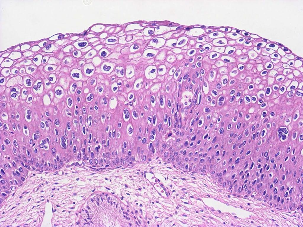CIN1 ( 軽度異形成 Mild dysplasia) 扁平上皮細胞の層形成や極性の乱れが 上皮の下層 1/3
