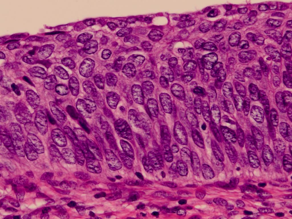 CIN3 ( 上皮内癌 Carcinoma in situ) 上皮全層にわたり