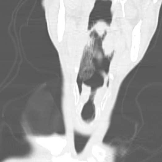 図 3: 死後 CT 像 喉頭に内腔を埋める陰影が認められる 喉頭蓋 声帯 気管 図 4 解剖時の肉眼像 声門下に泡沫状の痰の貯留があり