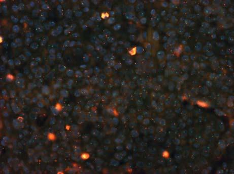 図 19 X 染色体 ( 赤 ), Y 染色体 ( 緑 ) 染色体 FISH 法 パラフィン切片 浸潤細胞のほとんどは Y 染色体 ( 緑 ) が陽性であることから ドナー由来のリンパ球が増殖したと判断された 3.
