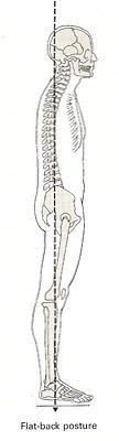 フラットバック 短い 腹筋群 ハムストリング 長い 股関節屈曲筋群